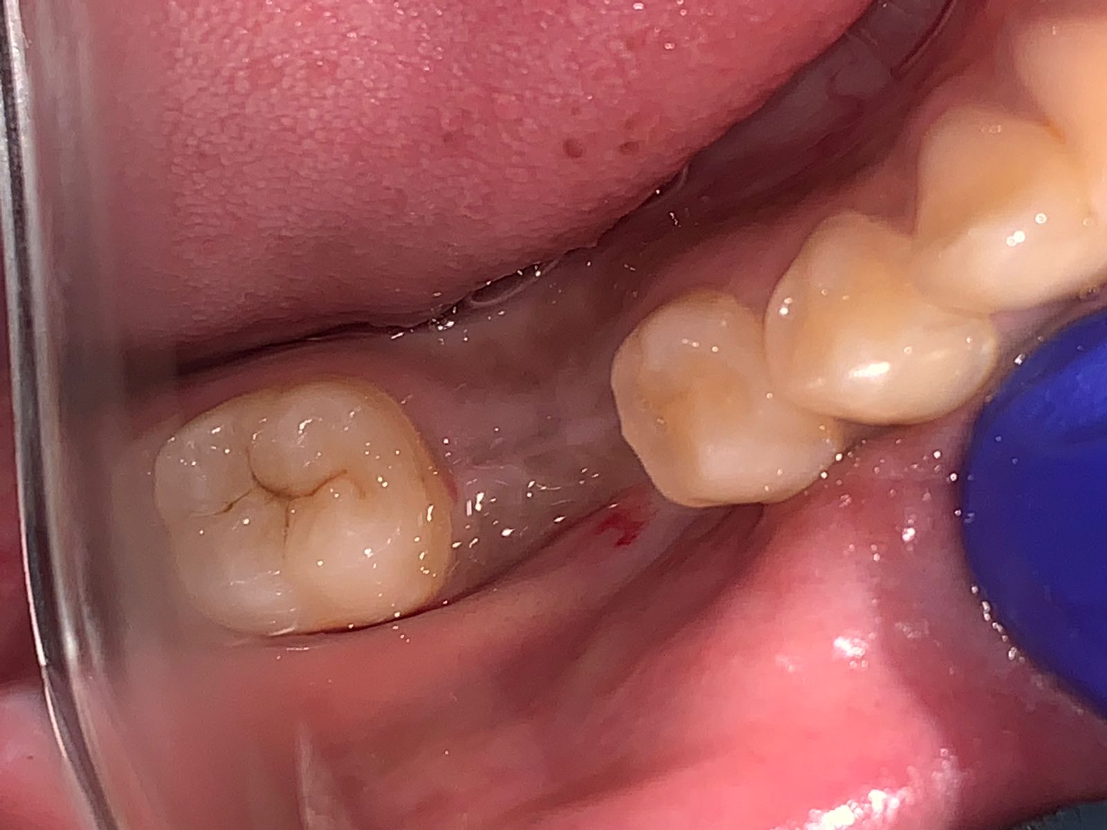 Single tooth replacement with implant before treatment